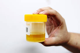 This image has an empty alt attribute; its file name is URINE.jpg